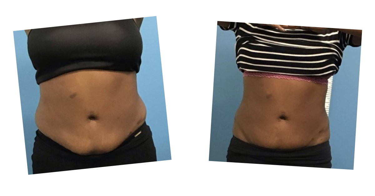 Abdomen before and after a course of Emerald Laser sessions